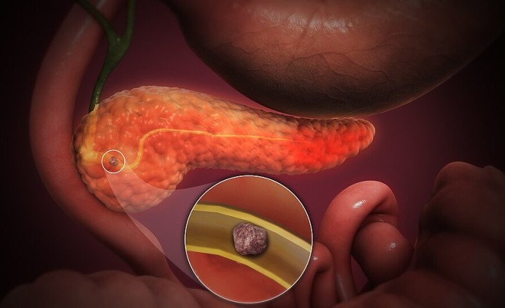 Pankreas ve Safra Yolları Cerrahisi 