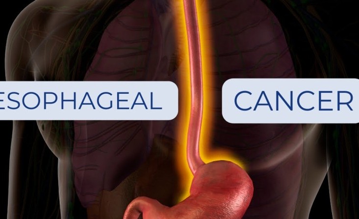 Yemek Borusu (Özofagus) Kanseri